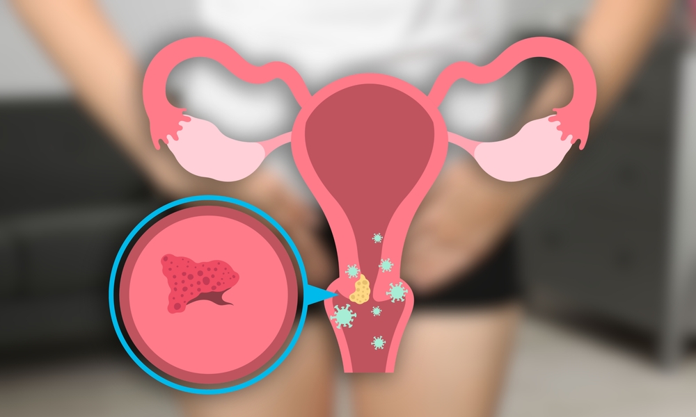 Symptome und Behandlung von Genitalwarzen bei Frauen
