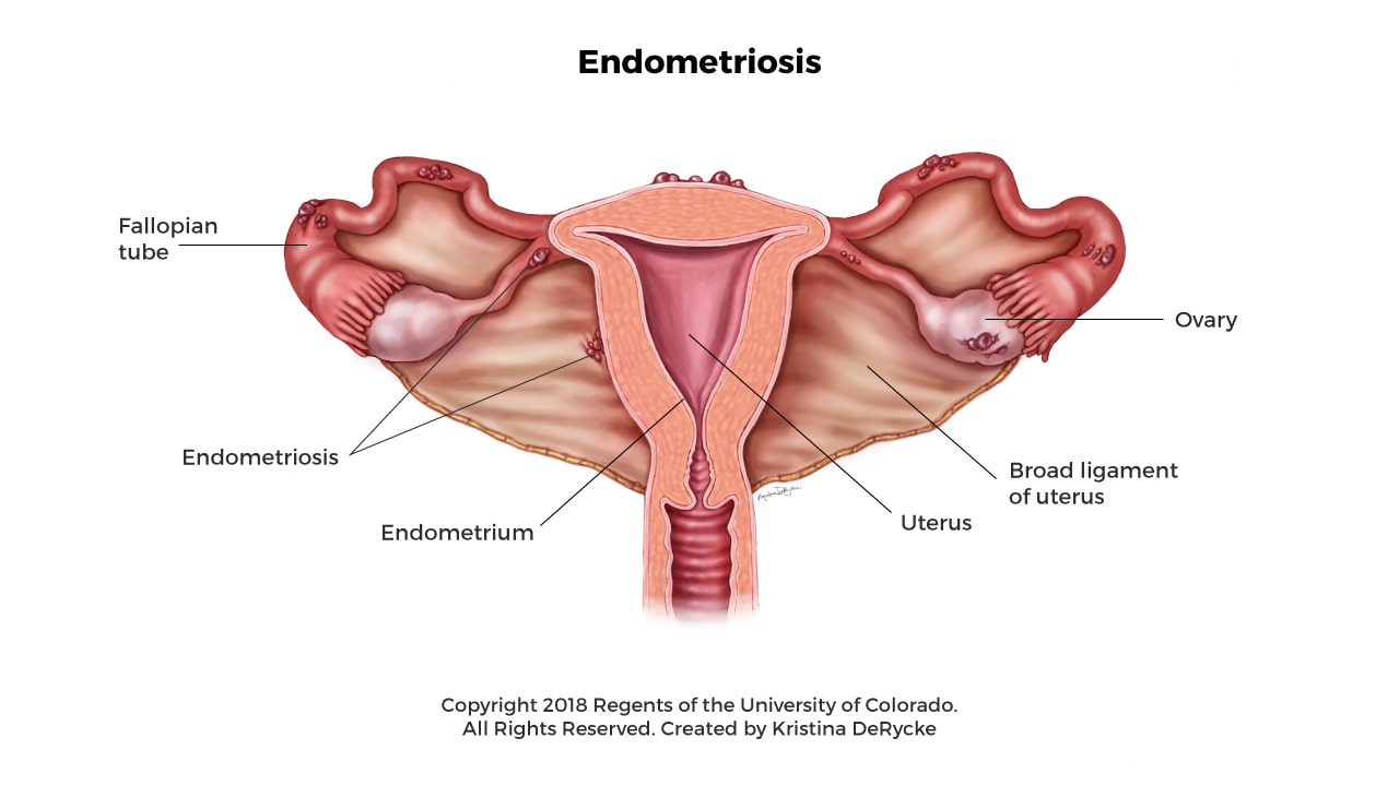 Endometrioma Tedavisi