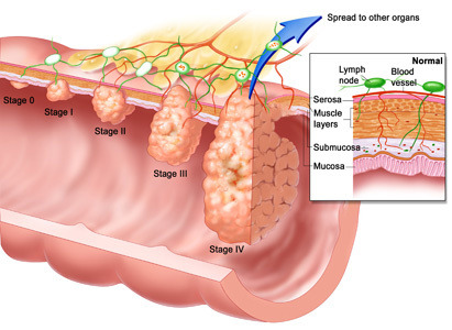Anal Kanser ve Hpv